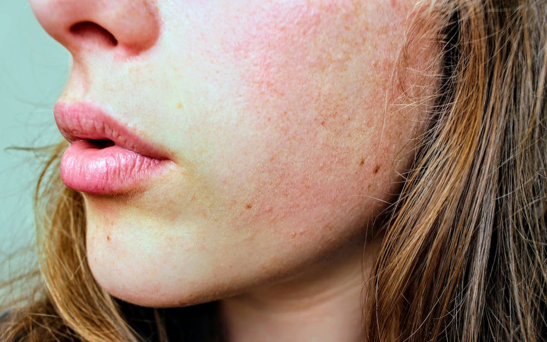When Will My Skin Stop Peeling from Tretinoin